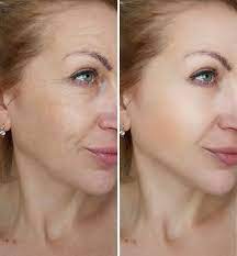 LASER SKIN RESURFACING