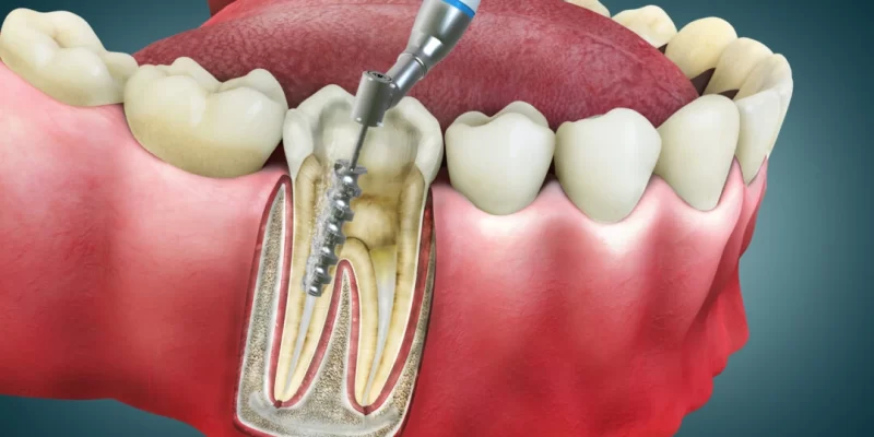 Root Canal Treatment