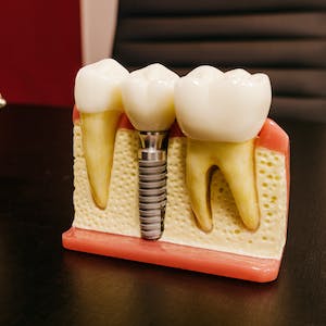 dental-implant-after-care