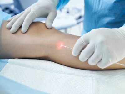 Uses Of Endovenous Laser Ablation To Treat Underlying Cause Of Varicose Veins