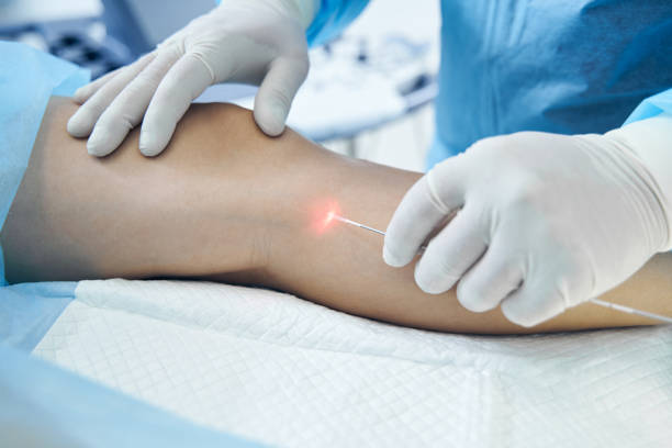 Uses Of Endovenous Laser Ablation To Treat Underlying Cause Of Varicose Veins