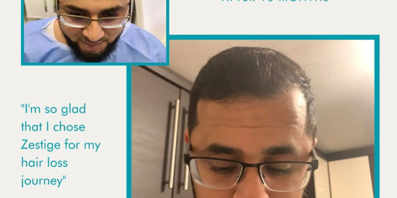 hair transplant healing time