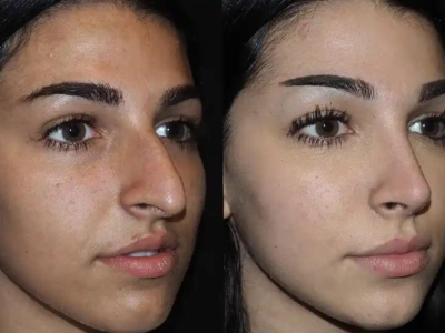 Understanding the Different Types of Rhinoplasty Procedures Available in Dubai