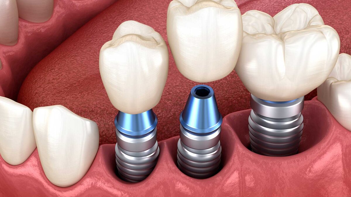 dental implants baton rouge