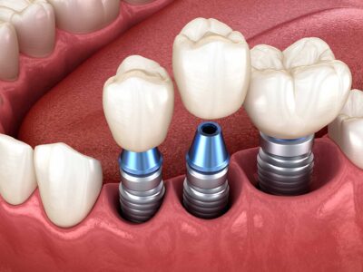 dental implants baton rouge