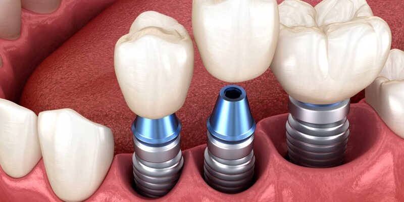 dental implants baton rouge