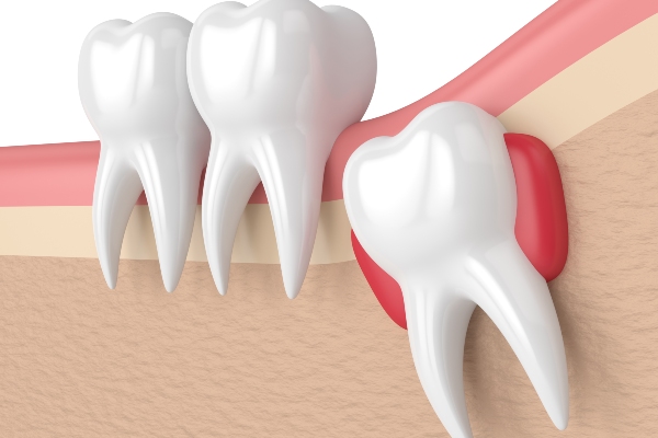 Types Of Dental Implants