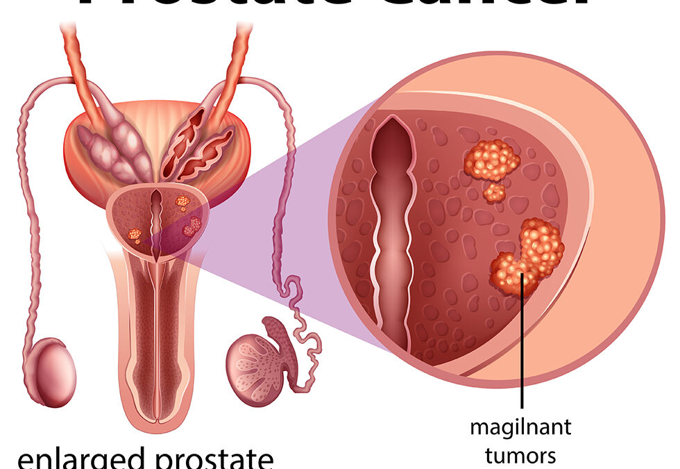 How quickly does prostate cancer develop | Punarjan Ayurveda Hospital