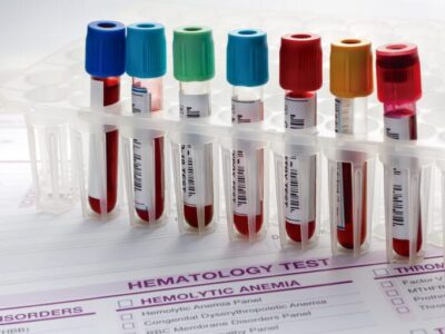 What to do when blood test results are not quite normal