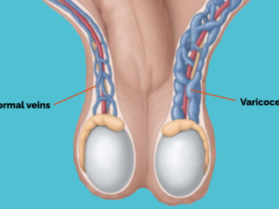 Swollen Testicular Veins