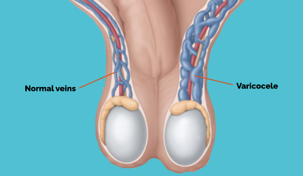 Swollen Testicular Veins
