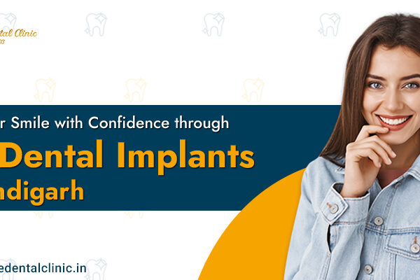 dental implants in chandigarh