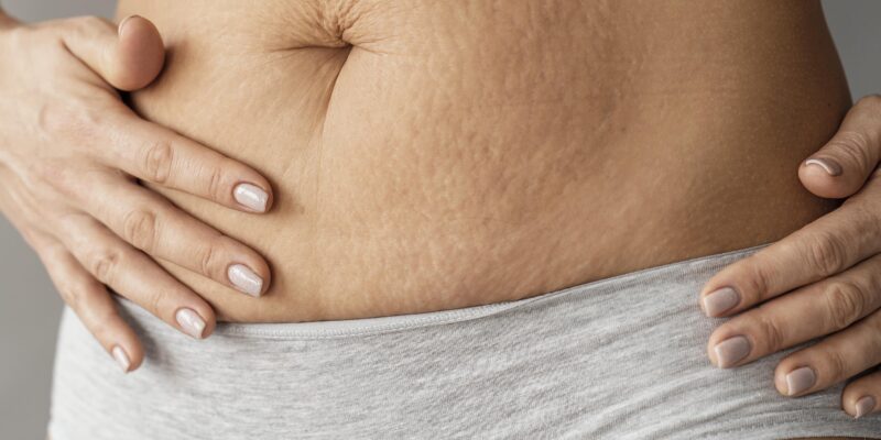 Stretch Marks Treatment in Mississauga