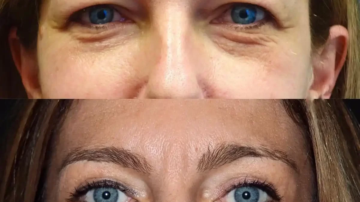 Before and After Real Results from Blepharoplasty in Dubai