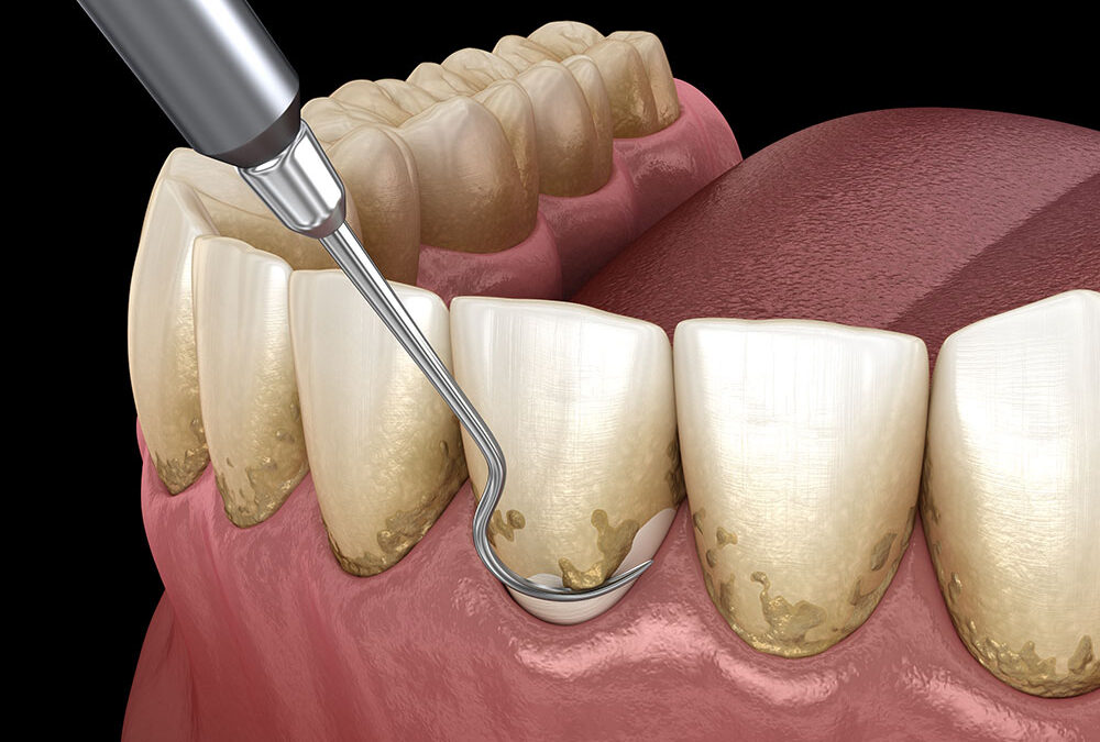 periodontal scaling and root planing