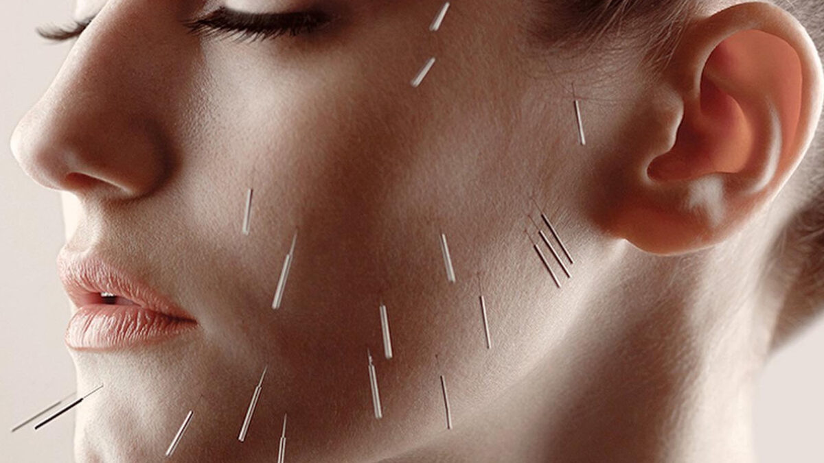 Facial Acupuncture