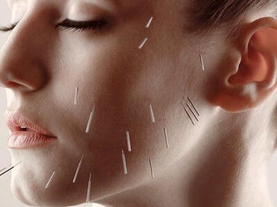 Facial Acupuncture