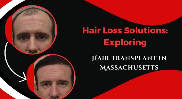 Hair-Loss-Solutions-Exploring-Hair-Transplant-in-Massachusetts