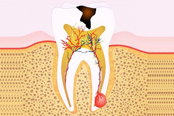 The Importance of Root Canal Treatment