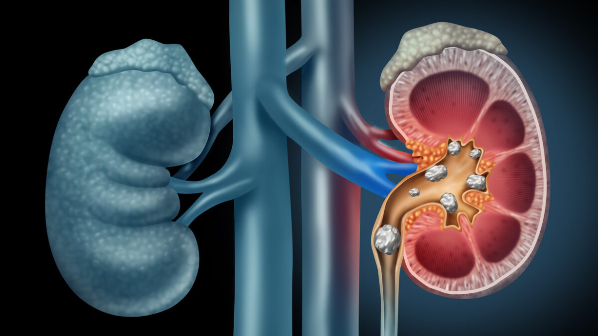 Human kidney Stones Medical Concept