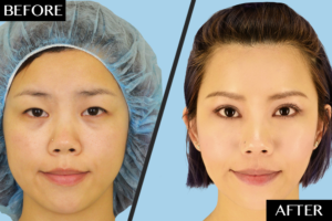 Eyelid surgery Cherry Hill, New Jersey