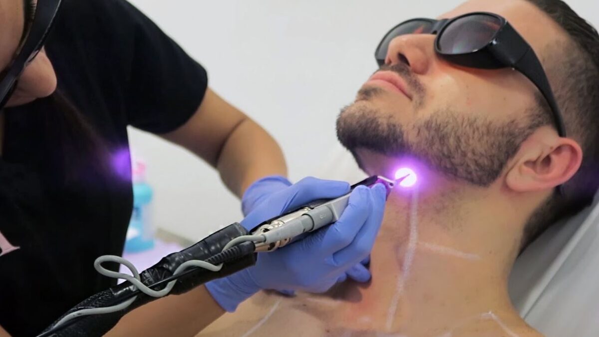 Beard Laser Hair Removal in Dubai