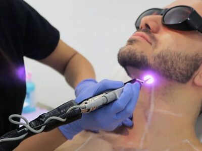 Beard Laser Hair Removal in Dubai