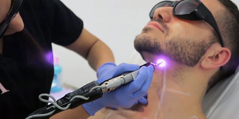 Beard Laser Hair Removal in Dubai