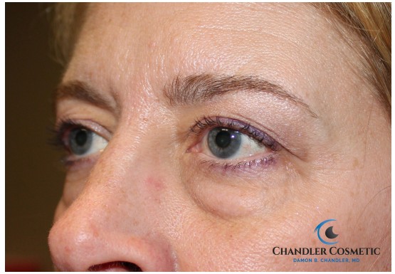 cherry hill eyelid surgery