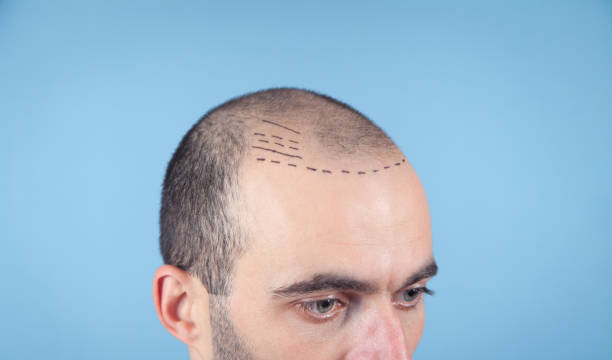 Hair Transplant in Riyadh