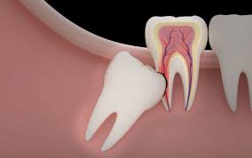 Tooth Extraction