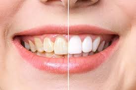 permanent teeth whitening