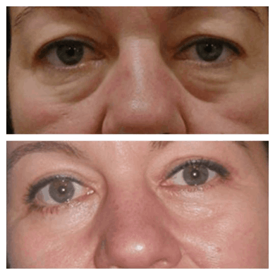 Eye Bag removal Surgery