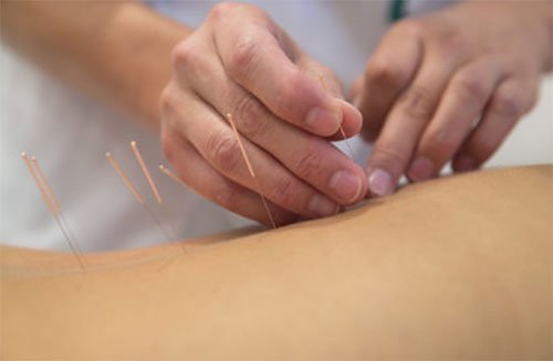 acupuncture