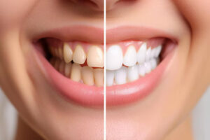 Teeth Whitening