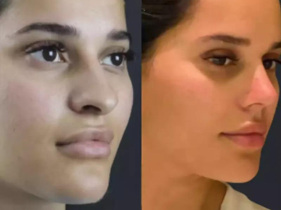 Rhinoplasty and Allergies: Managing Symptoms Post-Surgery in Dubai