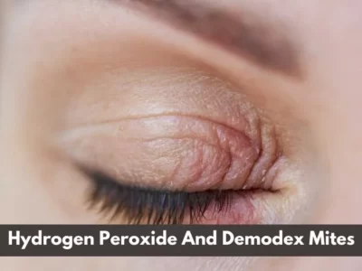 Hydrogen Peroxide Kills Demodex Mites