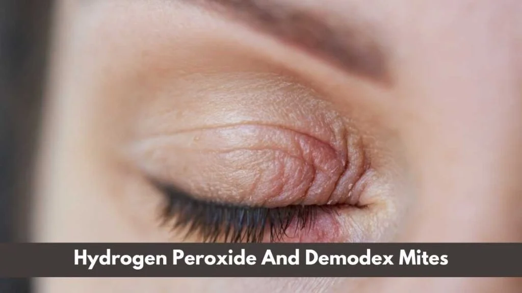 Hydrogen Peroxide Kills Demodex Mites