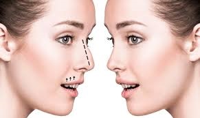 Rhinoplasty