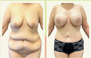 Tummy tuck Before Afdter