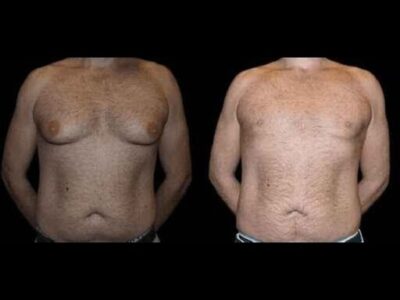 Before and After Male Breast Reduction Results