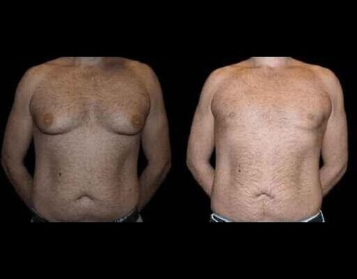 Before and After Male Breast Reduction Results