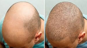 Hair Transplant Cost in Riyadh