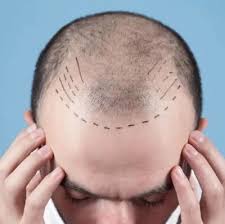 Hair Transplant in Riyadh