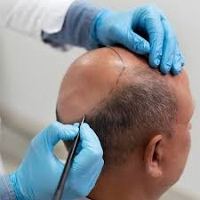 Hair Transplant Cost in Riyadh