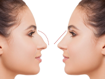 Rhinoplasty in Dubai