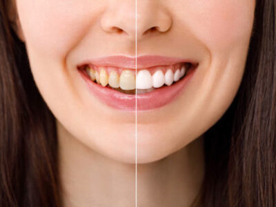 Teeth Whitening