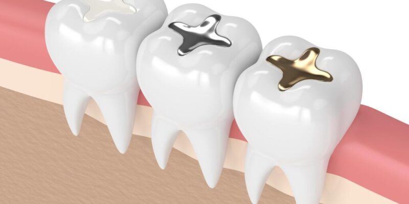 Dental Fillings