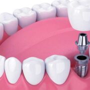 dental implants cost