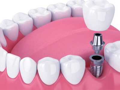 dental implants cost